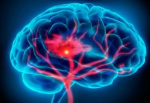 Estudio de Fleni muestra altas tasas de mortalidad y discapacidad a largo plazo tras un ACV en una comunidad argentina