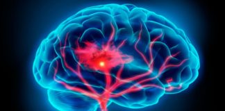 Estudio de Fleni muestra altas tasas de mortalidad y discapacidad a largo plazo tras un ACV en una comunidad argentina