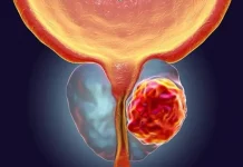 El tumor que más afecta a los hombres no da síntomas, pero se puede detectar a tiempo con un simple análisis de sangre
