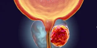 El tumor que más afecta a los hombres no da síntomas, pero se puede detectar a tiempo con un simple análisis de sangre