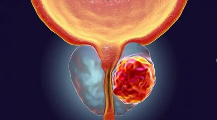 cancer-prostata-1-herramientas