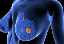 Cáncer de mama después de los 70: por qué son las pacientes más afectadas y cómo son los tratamientos