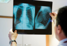 Cáncer de pulmón: un nuevo informe revela el estado de la enfermedad en el país y los desafíos por enfrentar en su abordaje