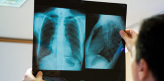 Cáncer de pulmón: un nuevo informe revela el estado de la enfermedad en el país y los desafíos por enfrentar en su abordaje