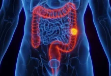 Cáncer colorrectal: un tumor frecuente que se puede prevenir y que afecta a pacientes cada vez más jóvenes