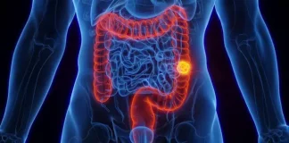 Cáncer colorrectal: un tumor frecuente que se puede prevenir y que afecta a pacientes cada vez más jóvenes
