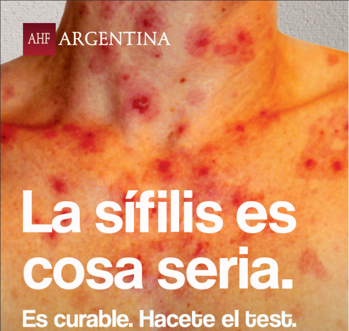 La sífilis es cosa seria